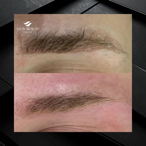 Before and after eyebrow laser treatment showing hair removal results from Leox Beauty Laser