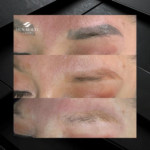Before and after comparison of eyebrow microblading results by I-Fox Beauty Laser showing three stages of brow enhancement