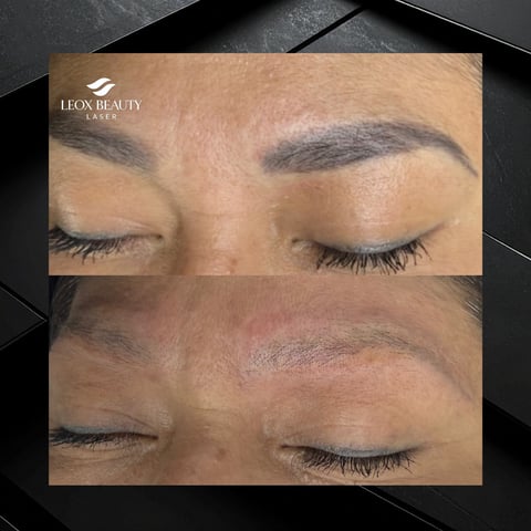 Before and after comparison of eyebrows treatment by Leox Beauty Laser, showing improved brow definition and shape