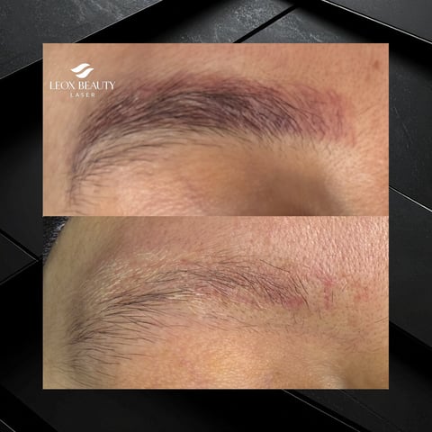 Before and after eyebrow microblading treatment by Leon Beauty Laser showing fuller, defined brows